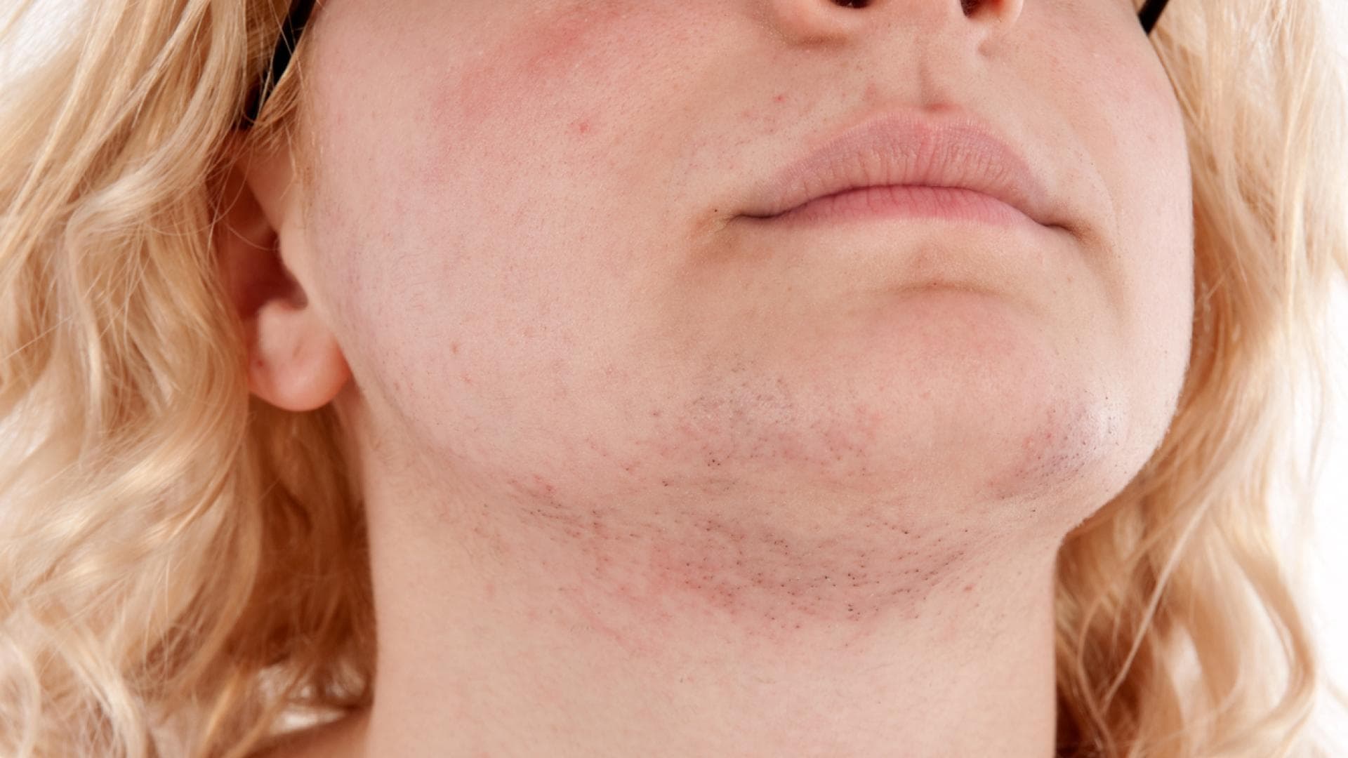 Junge Frau mit Testosteronüberschuss und Kinnbart. Junge Frau mit Testosteronüberschuss und Kinnbart.