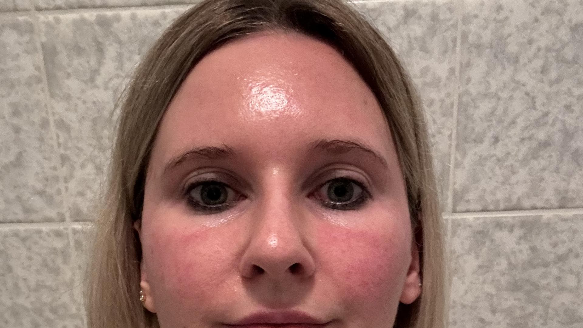 Nach der Gua Sha Massage Nach der Gua Sha Massage
