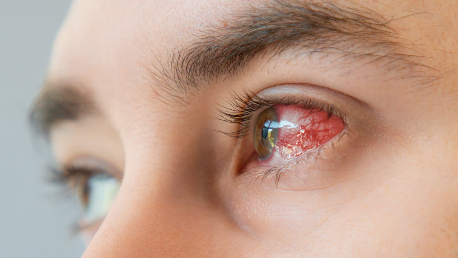 Geplatzte Adern im Auge sind in den meisten Fällen harmlos und verschwinden. Geplatzte Adern im Auge sind in den meisten Fällen harmlos und verschwinden.