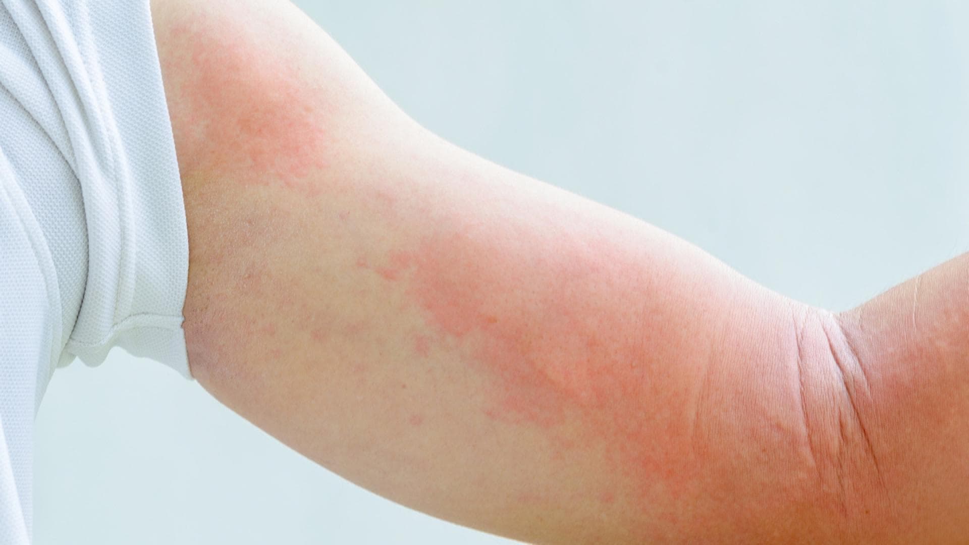 Armbeuge mit Ausschlag Armbeuge mit Ausschlag