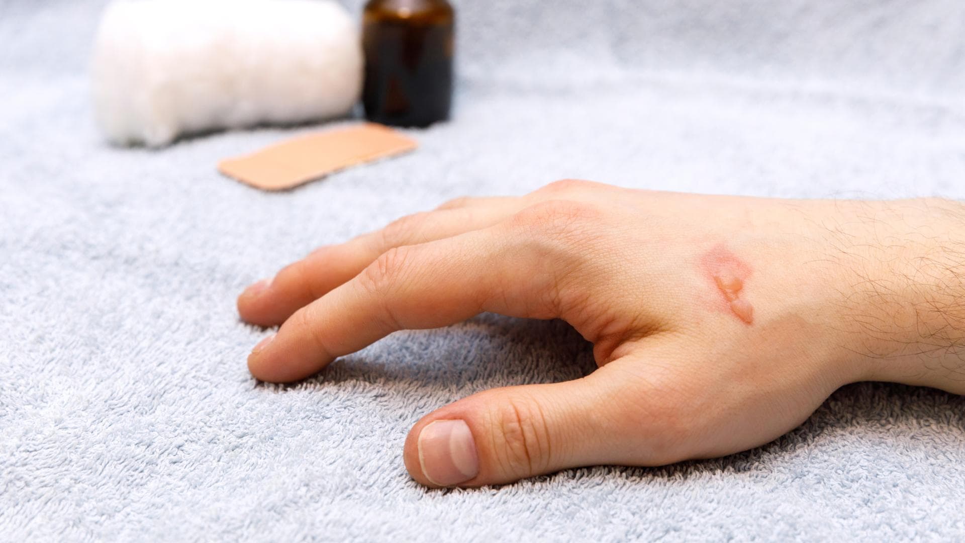 Hand mit Brandblase 