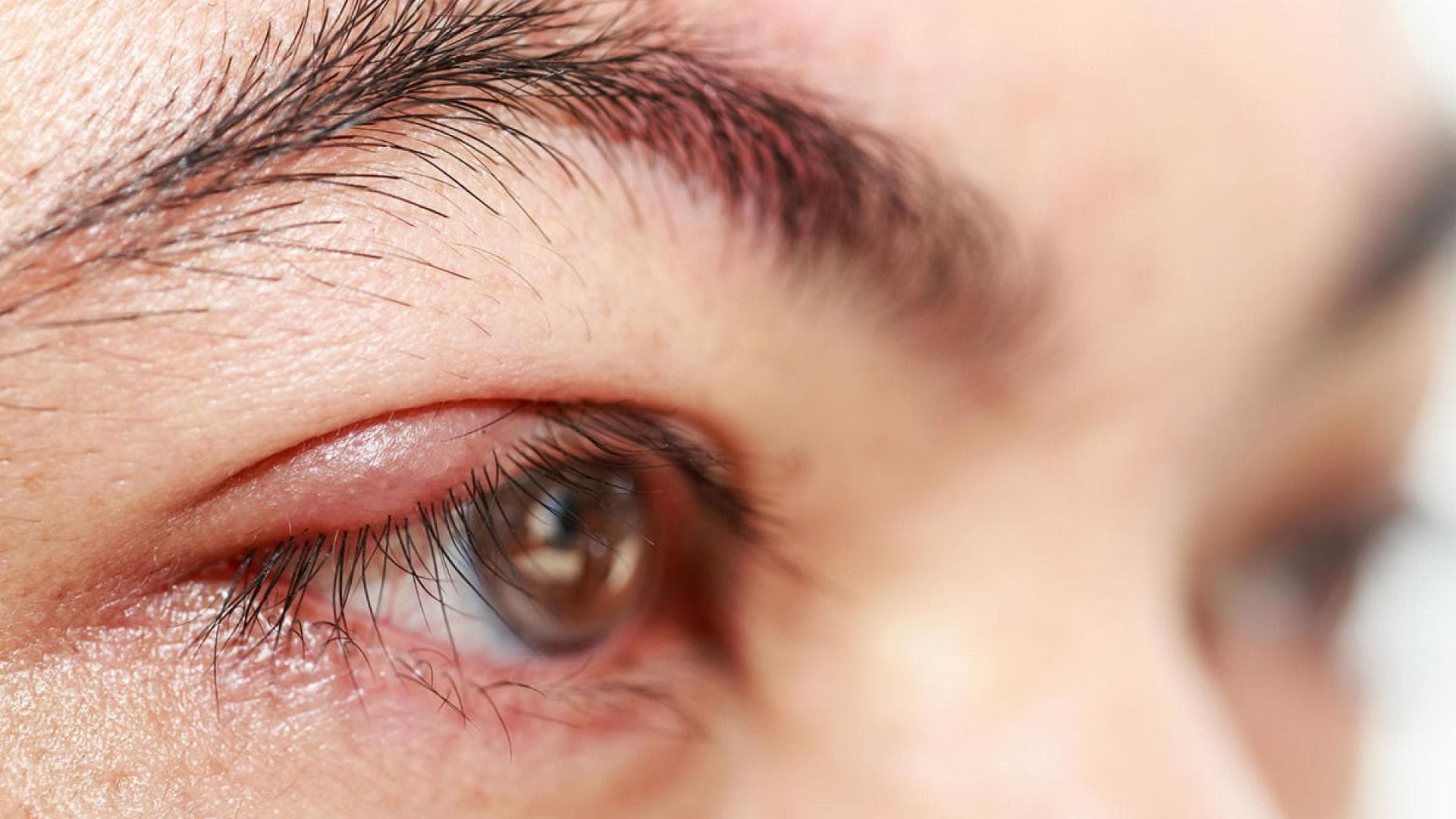 Gerstenkorn Entzuendung am Auge Gerstenkorn Entzuendung am Auge