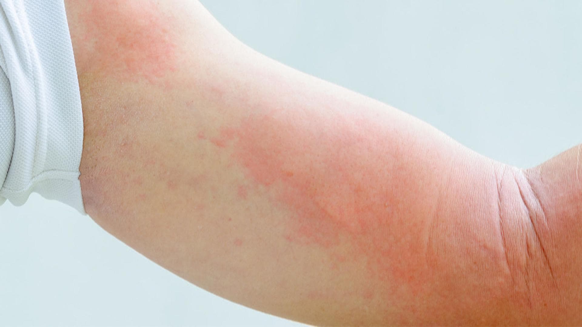 Nesselsucht als allergiesche Reaktion Nesselsucht als allergiesche Reaktion