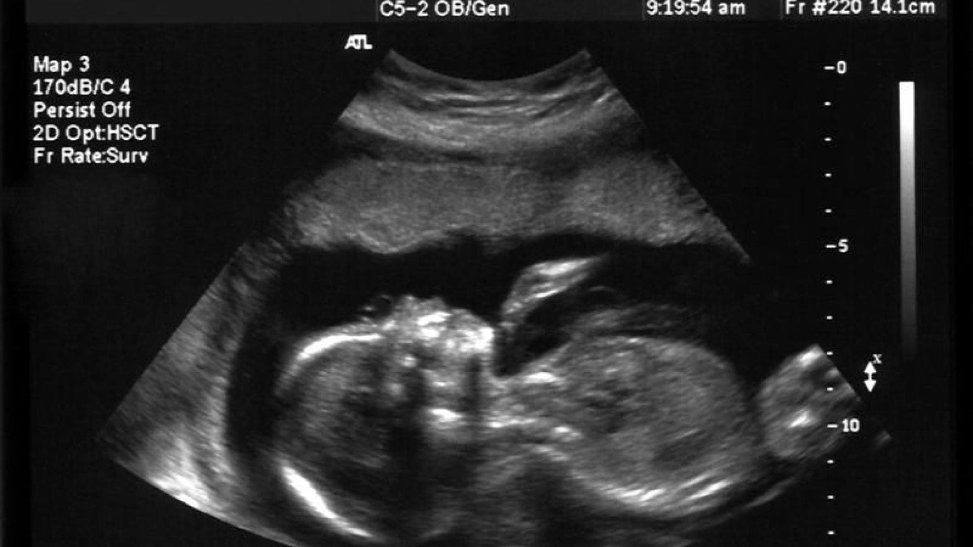 Baby im Mutterleib auf Ultraschallbild