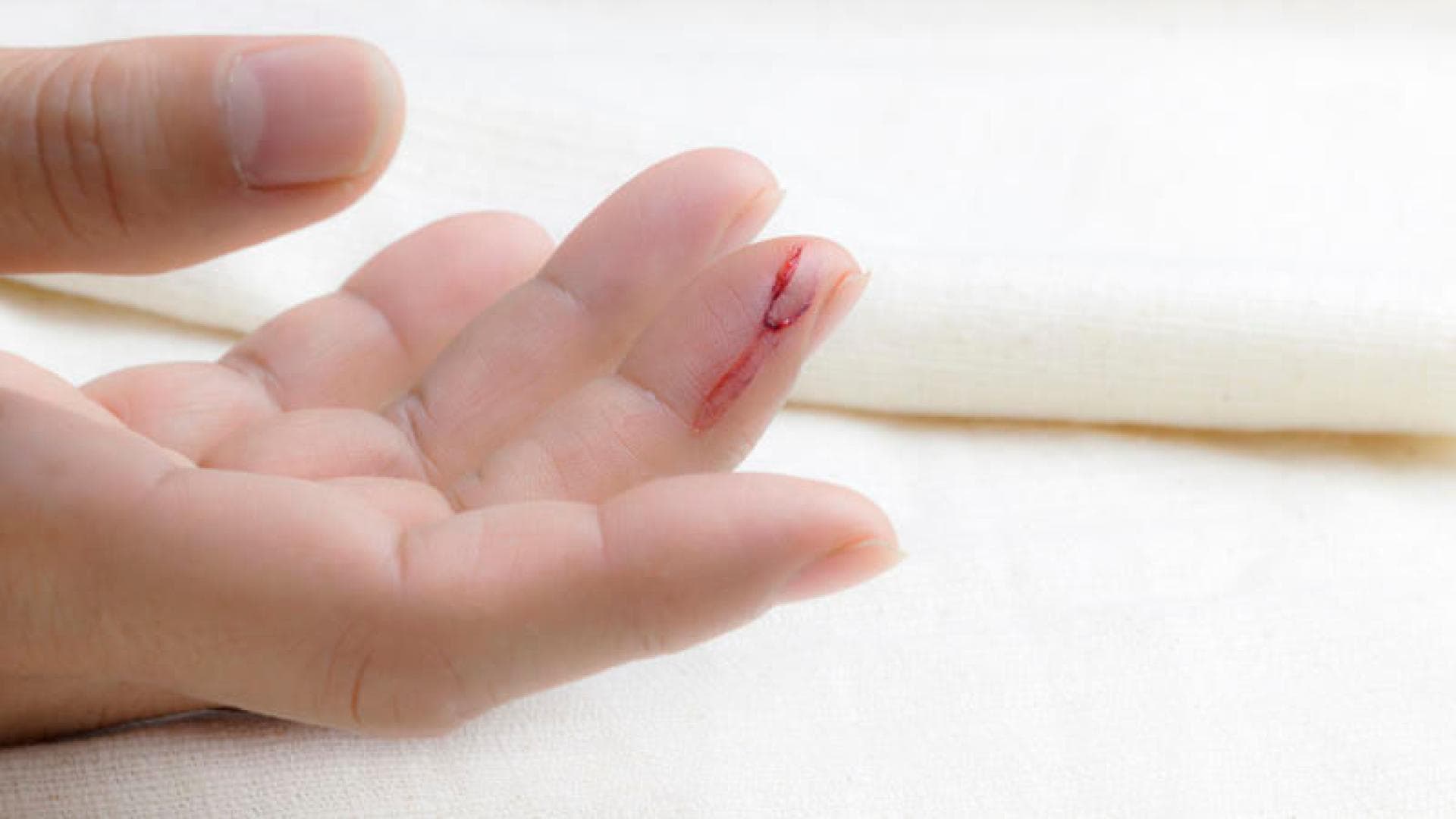 Wunde an der Hand
