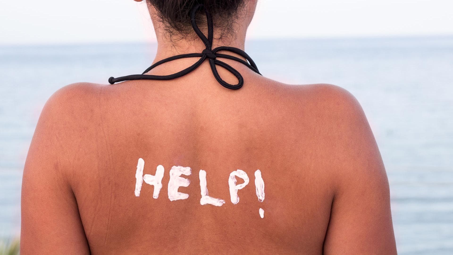 Frau mit Sonnenbrand und Sonnencreme auf dem Rücken