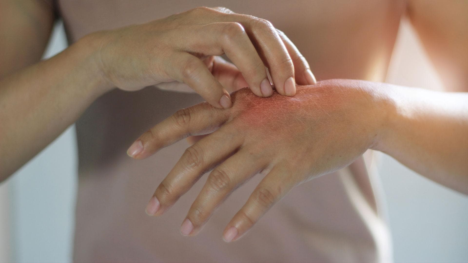 Neurodermitis_Hand Frau kratzt sich an geröteter Hand, Neurodermitis