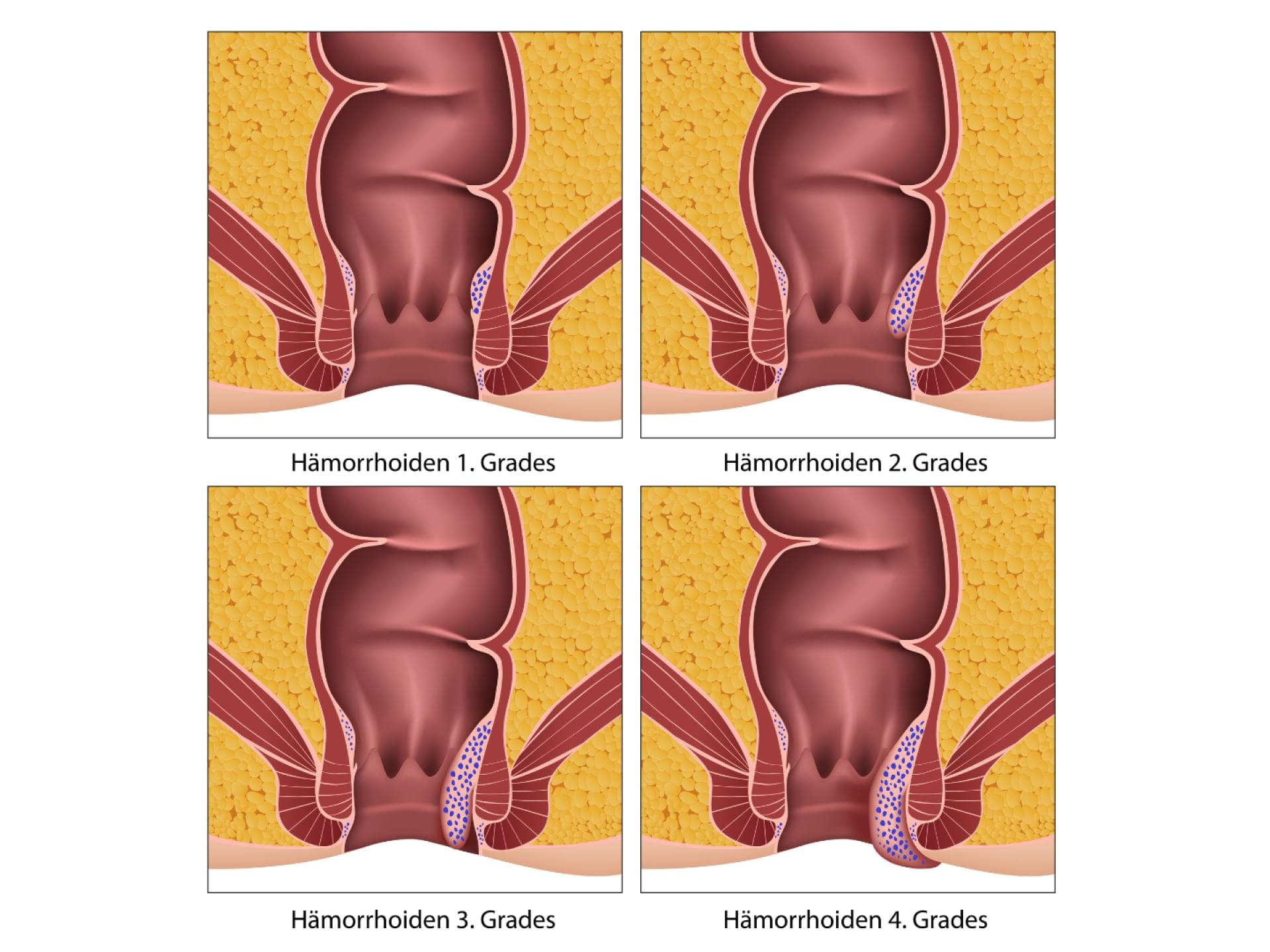 Hämorrhoiden Grafik