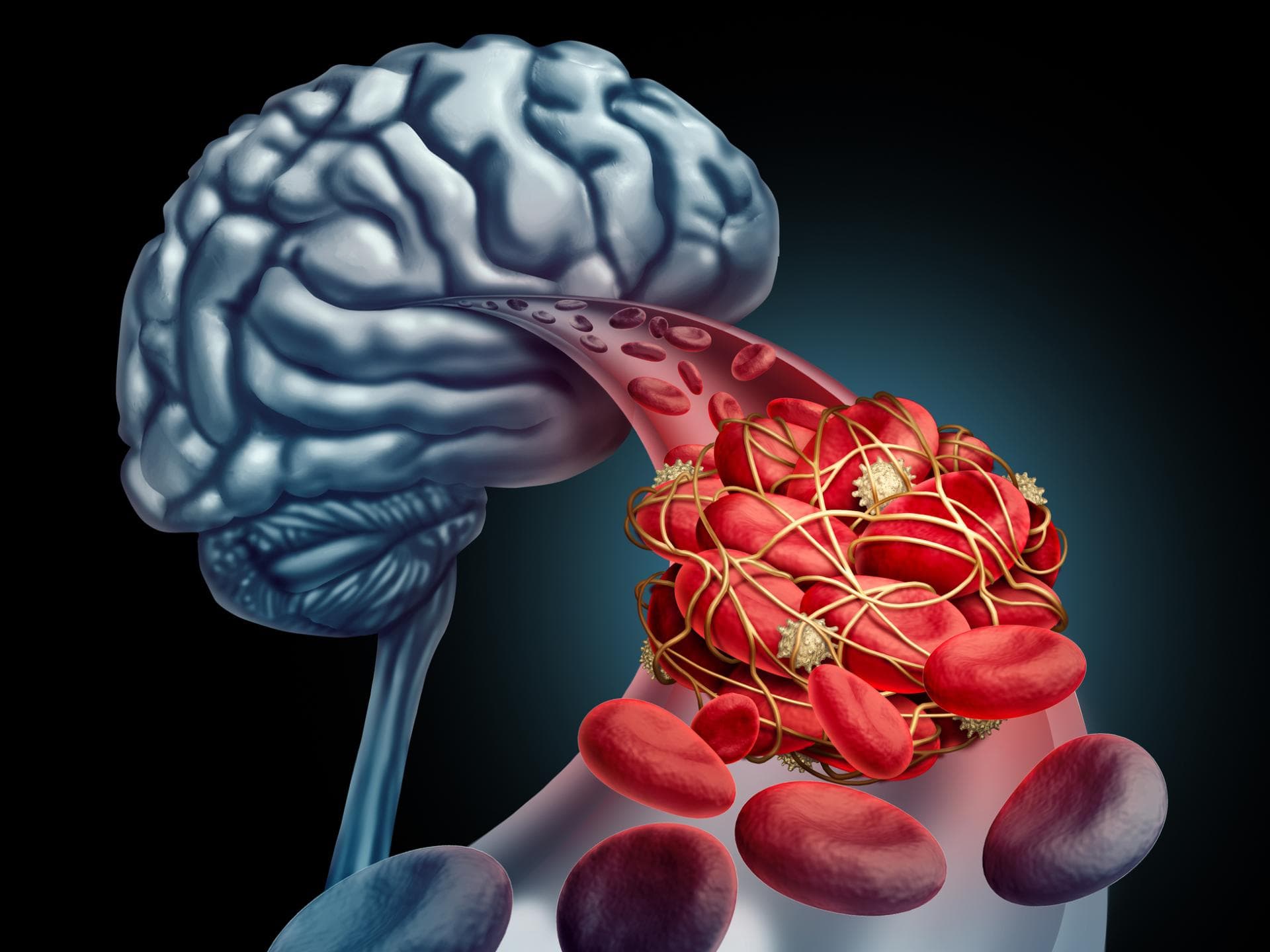 Hirnvenenthrombose
