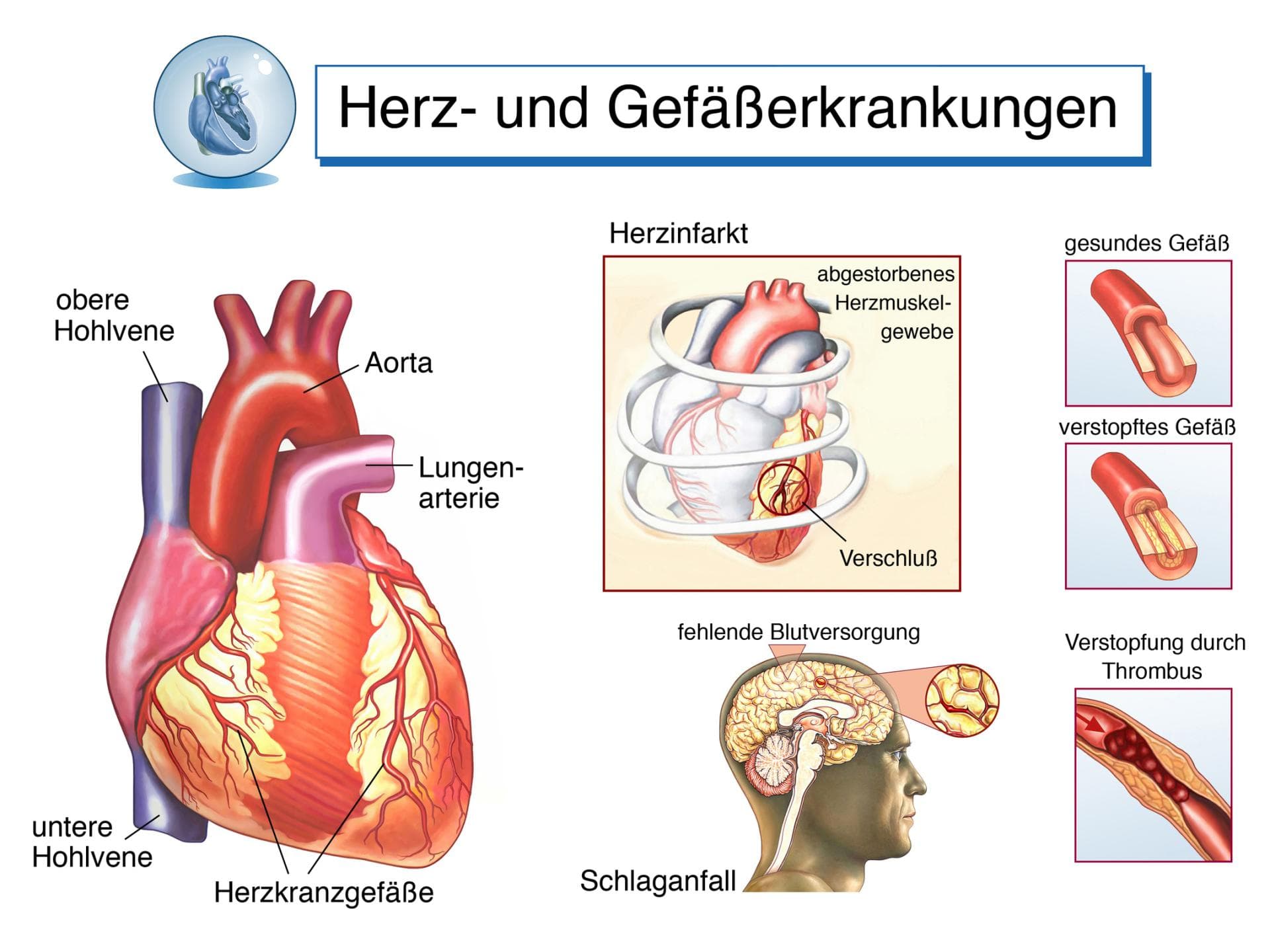 Infografik zu Herz- und Gefäßerkrankungen