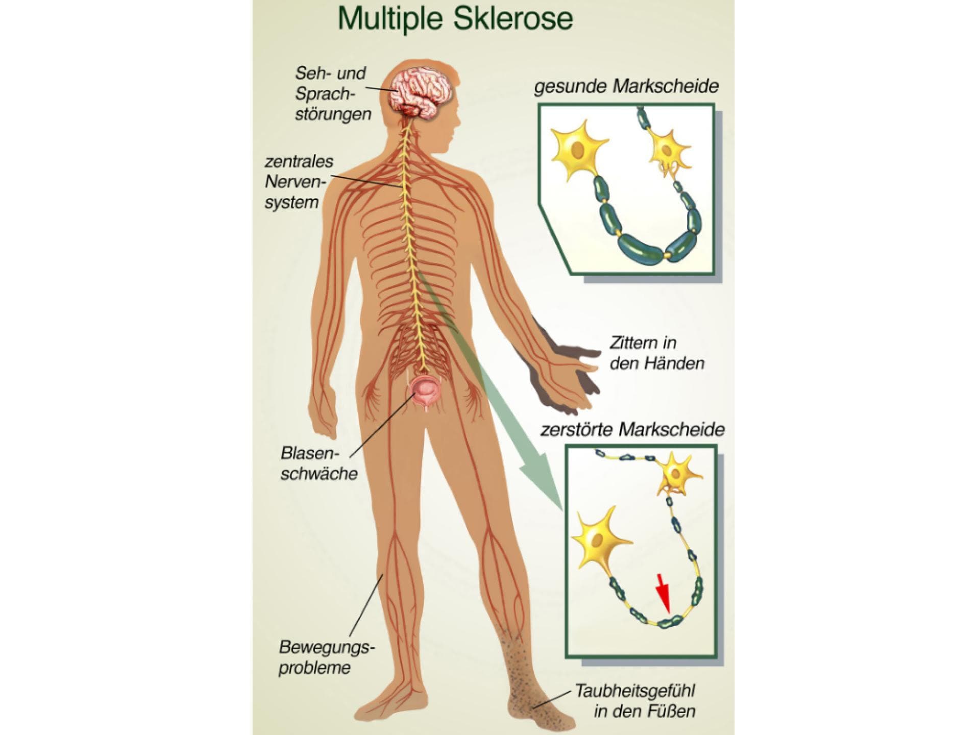 Grafische Darstellung der Krankheit Multiple Sklerose