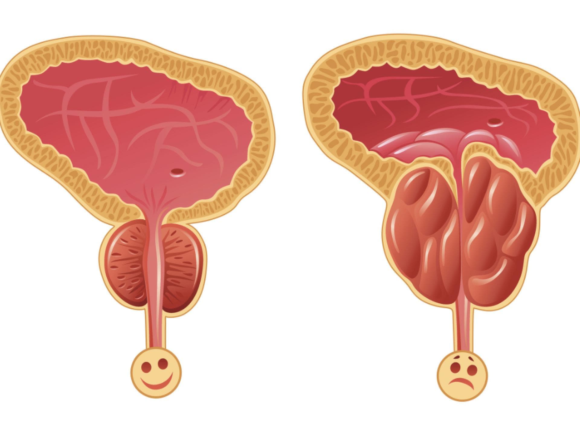 Grafik einer gesunden Prostata und einer vergrößerten Prostata
