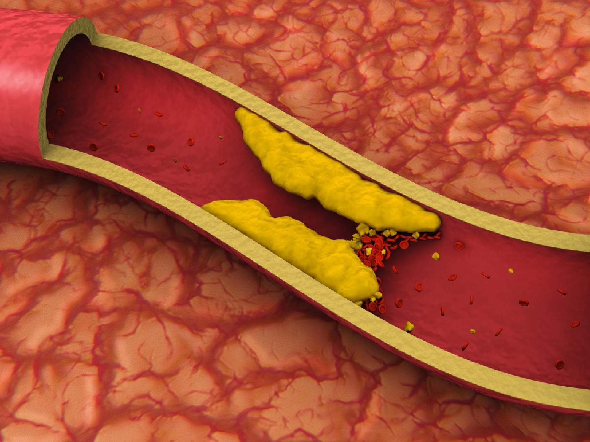 Verstopfte Arterie
