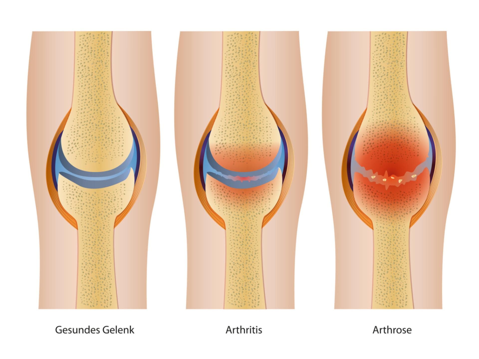 Grafische Darstellung von Arthritis und Arthrose