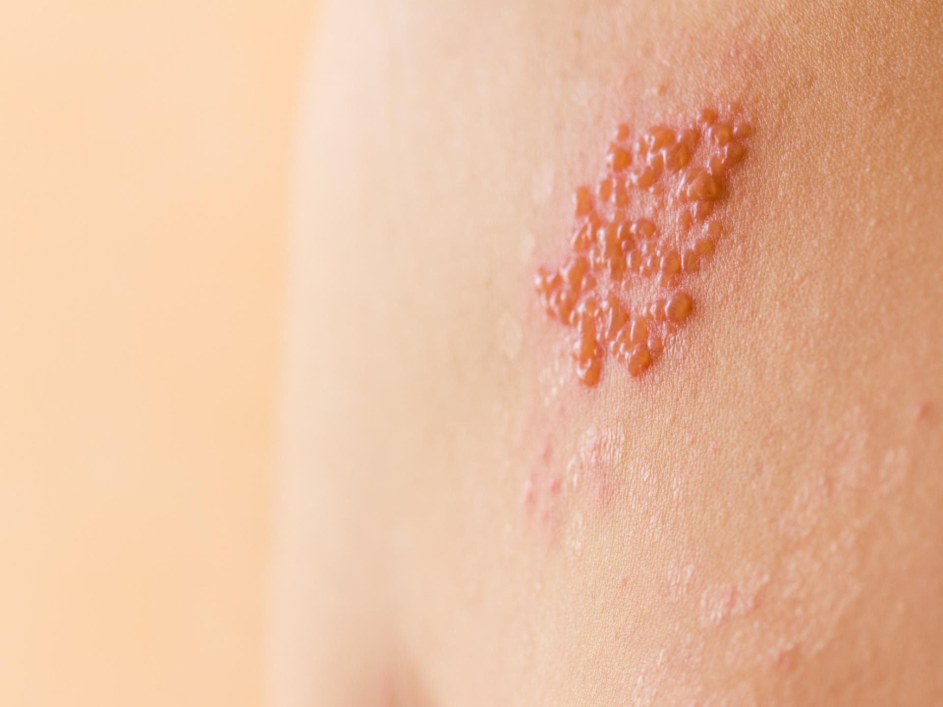 Starke Belastungen können das Immunsystem schwächen und zu Gürtelrose führen. Starke Belastungen können das Immunsystem schwächen und zu Gürtelrose führen.
