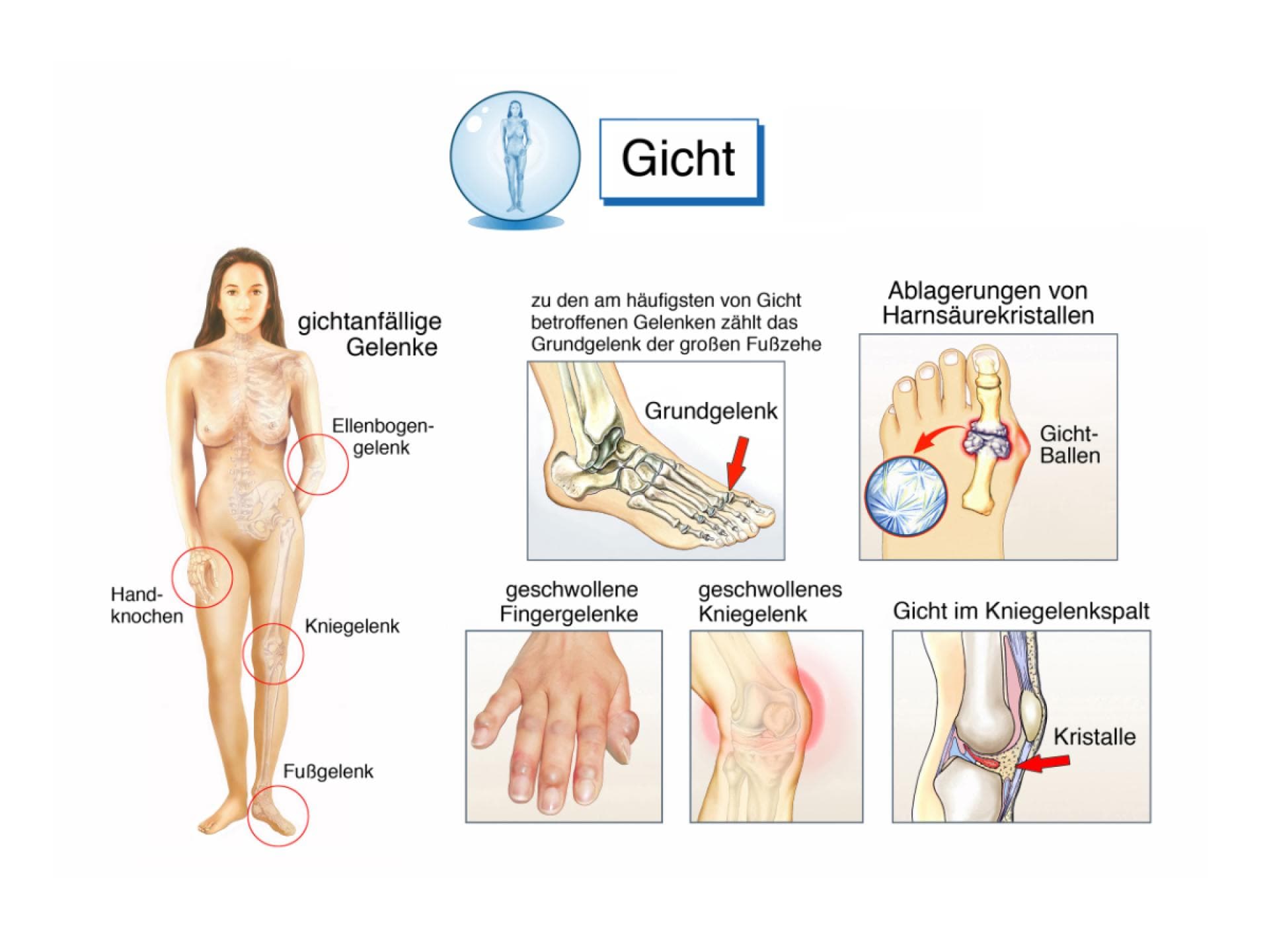 Infografik zur Gicht