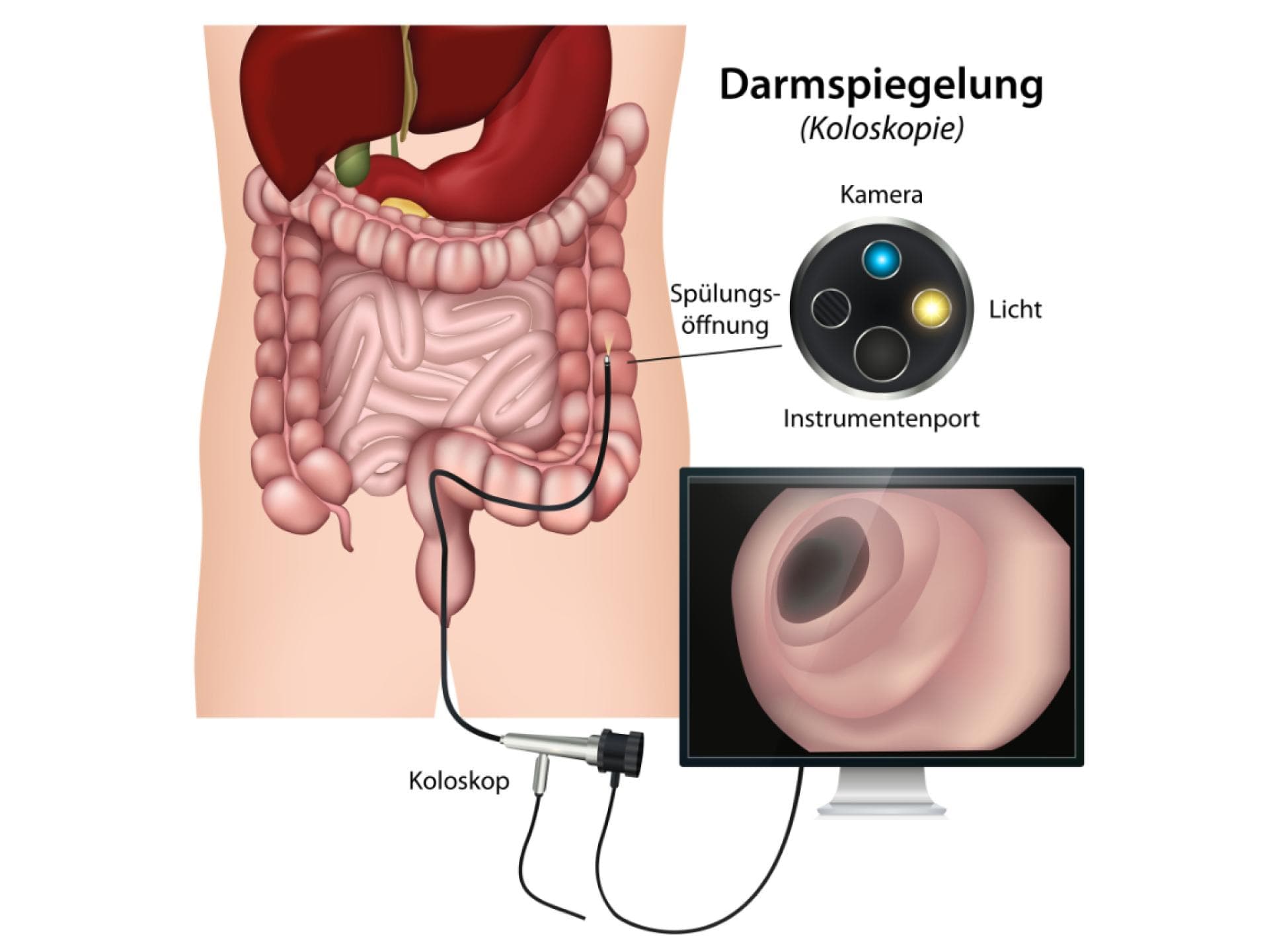 Grafische Darstellung einer Darmspiegelung