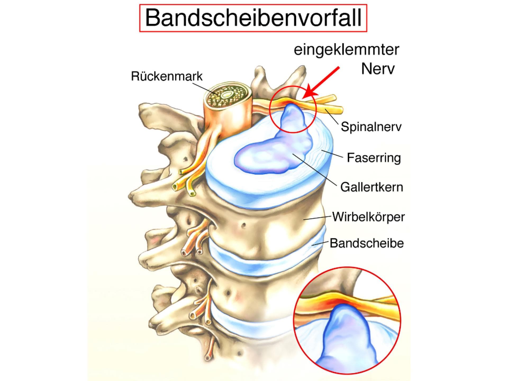 Grafische Darstellung eines Bandscheibenvorfalls