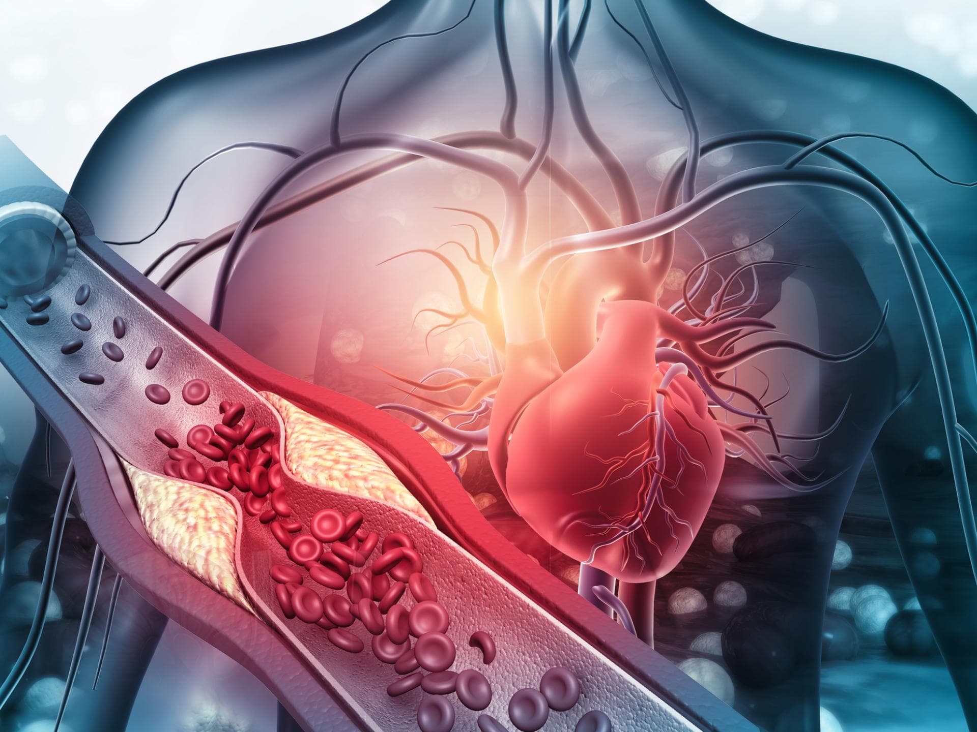 Herz verstopfte Arterien Herz verstopfte Arterien