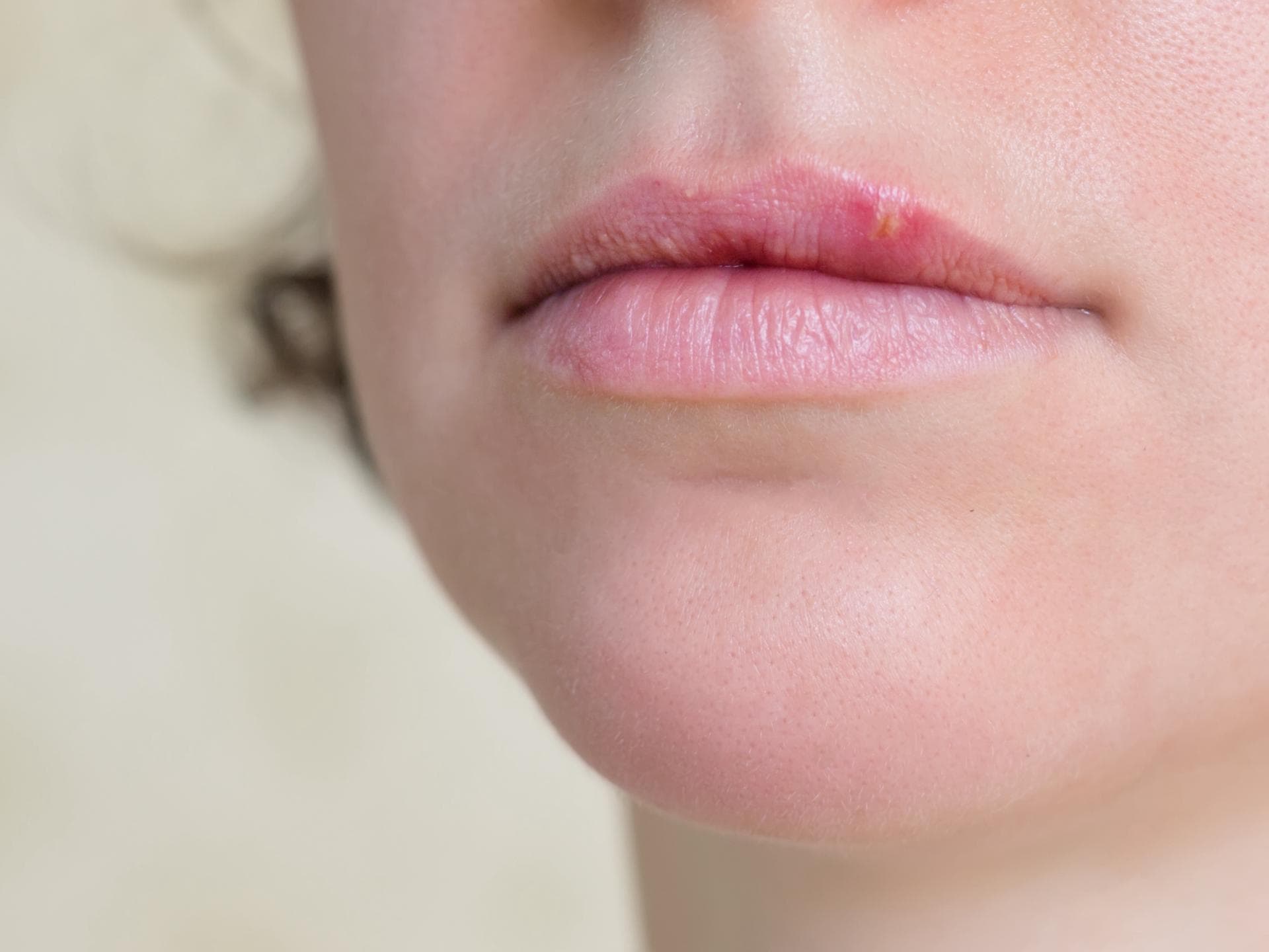 Frau mit Lippenherpes