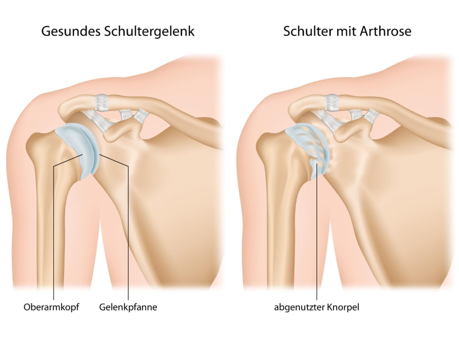 Grafische Darstellung einer Schulterarthrose
