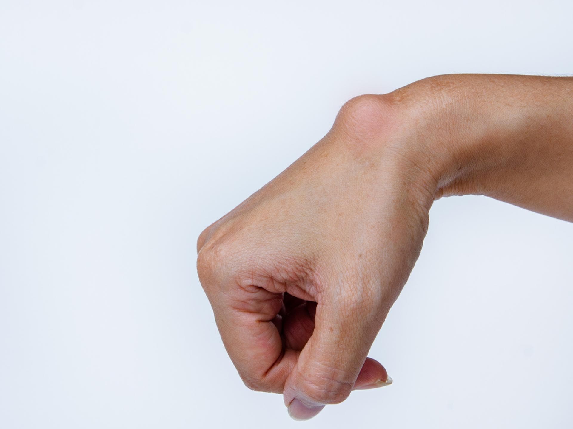 Ganglion am Handgelenk