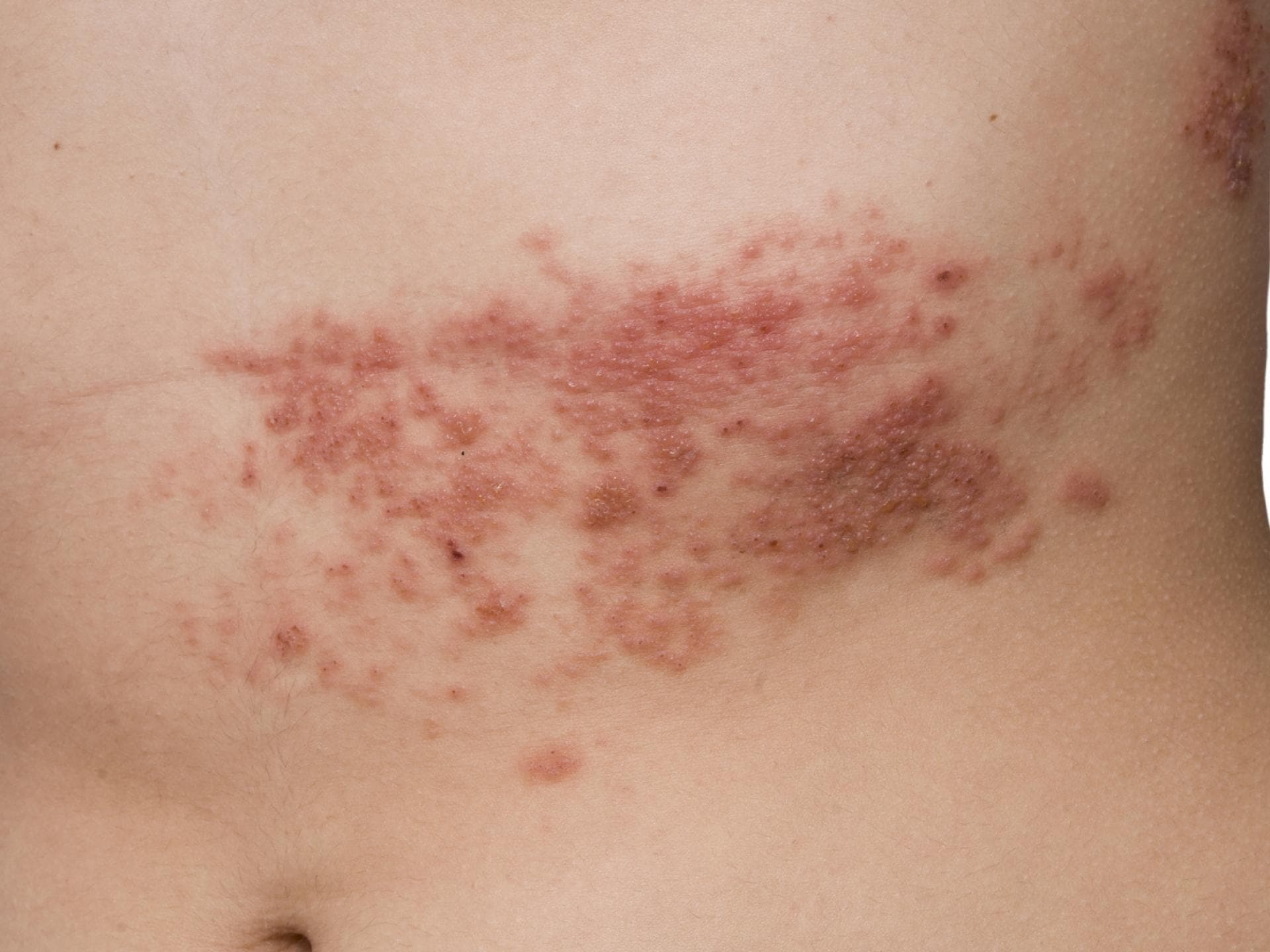 Gürtelrose mit typischem Hautausschlag am Torso.