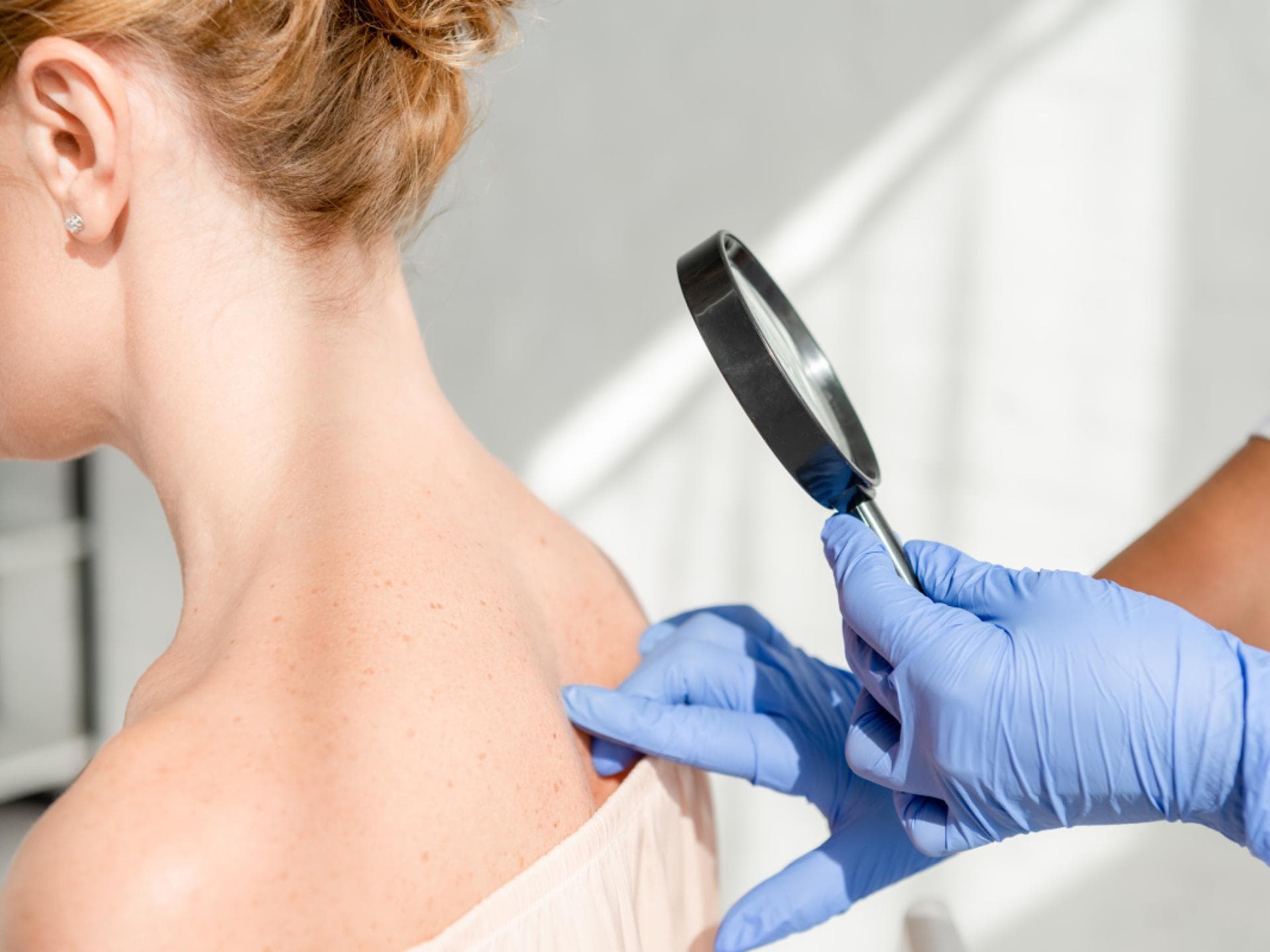 Die Krankenkassen übernehmen die Kosten für die Vorsorgeuntersuchung beim Hautarzt ab dem Alter von 35 Jahren Hautkrebs ist die häufigste Krebsart in Deutschland.