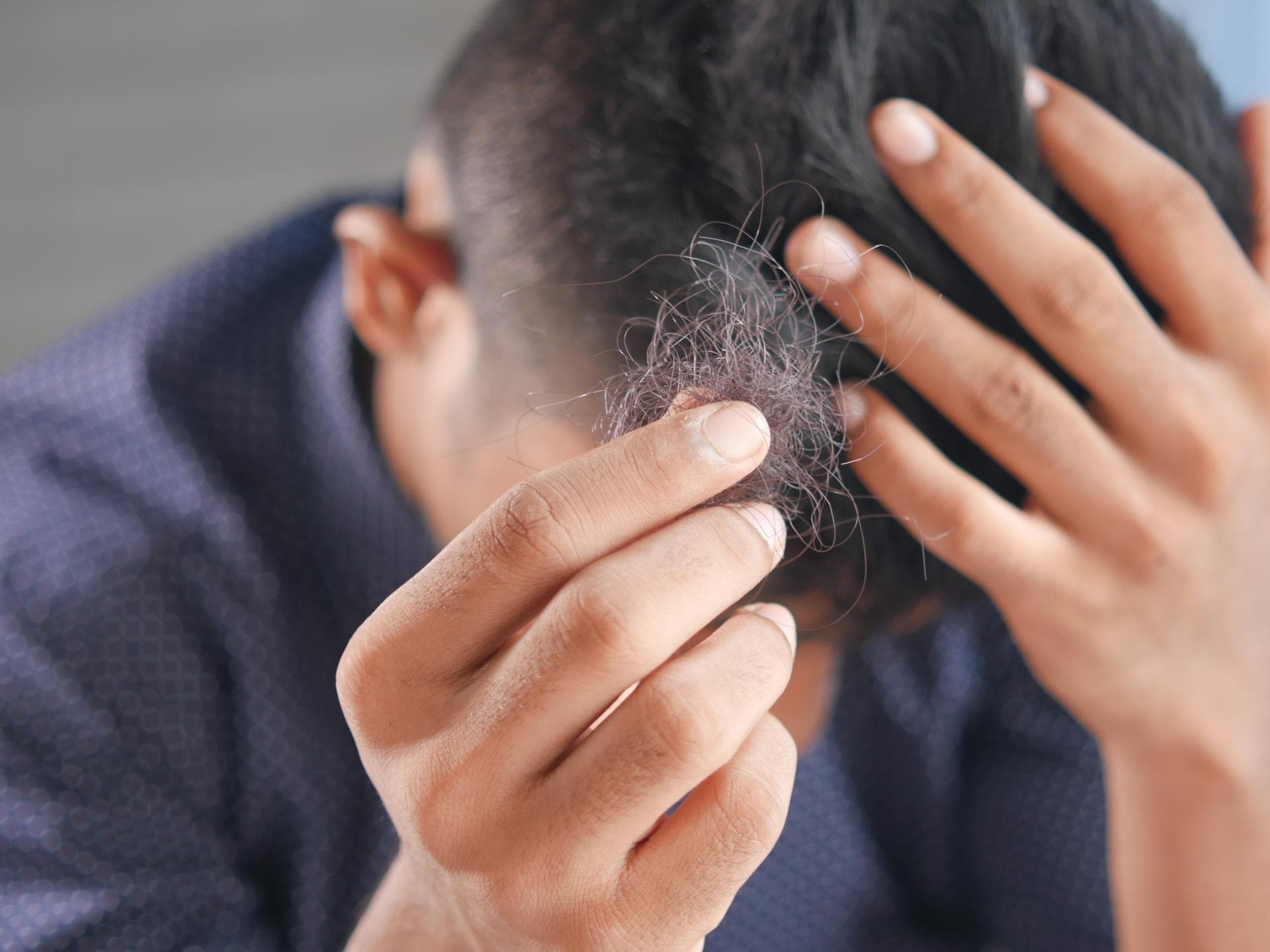 Mann hält Haarbüschel in der Hand