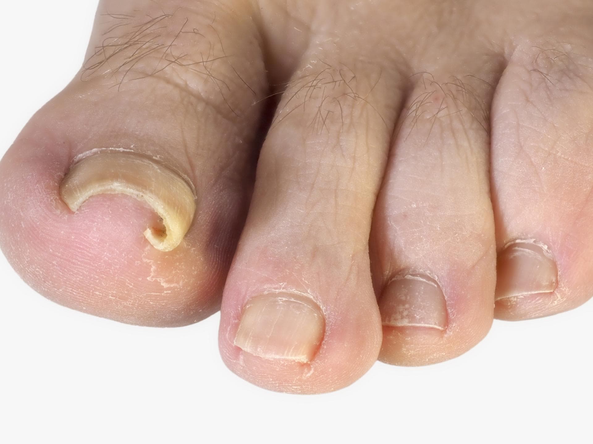 Rollnägel sind schmerzhafte Nagelveränderungen Rollnagel