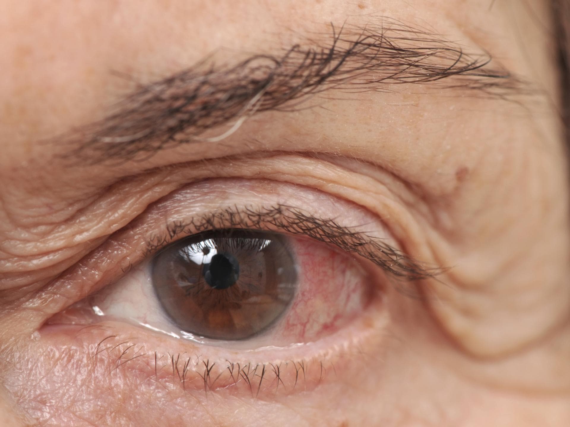 Auge eines älteren Mannes mit Bindehautentzündung zeigt Symptome wie Rötungen und Schwellungen