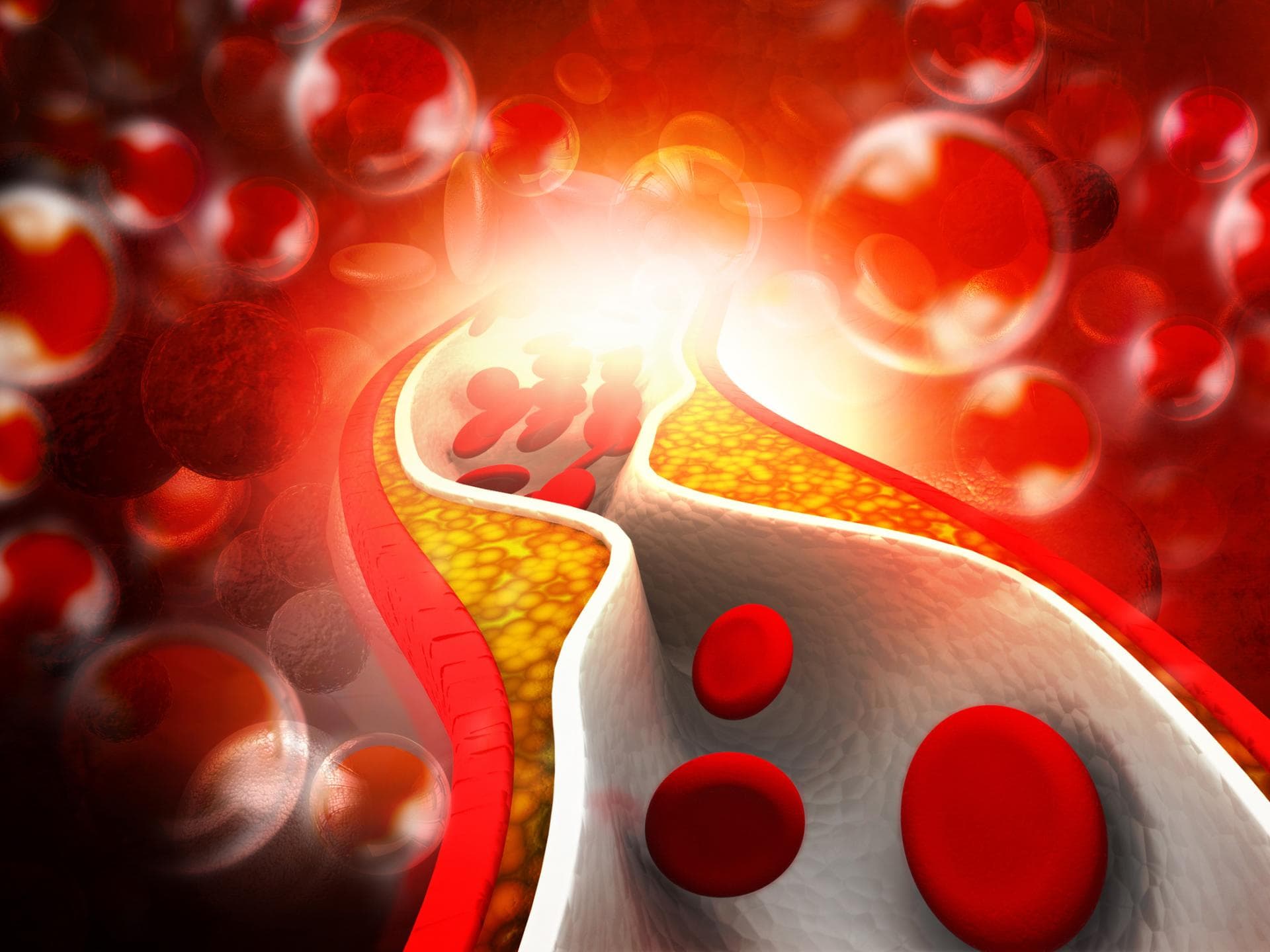 Verkalkte Arterie