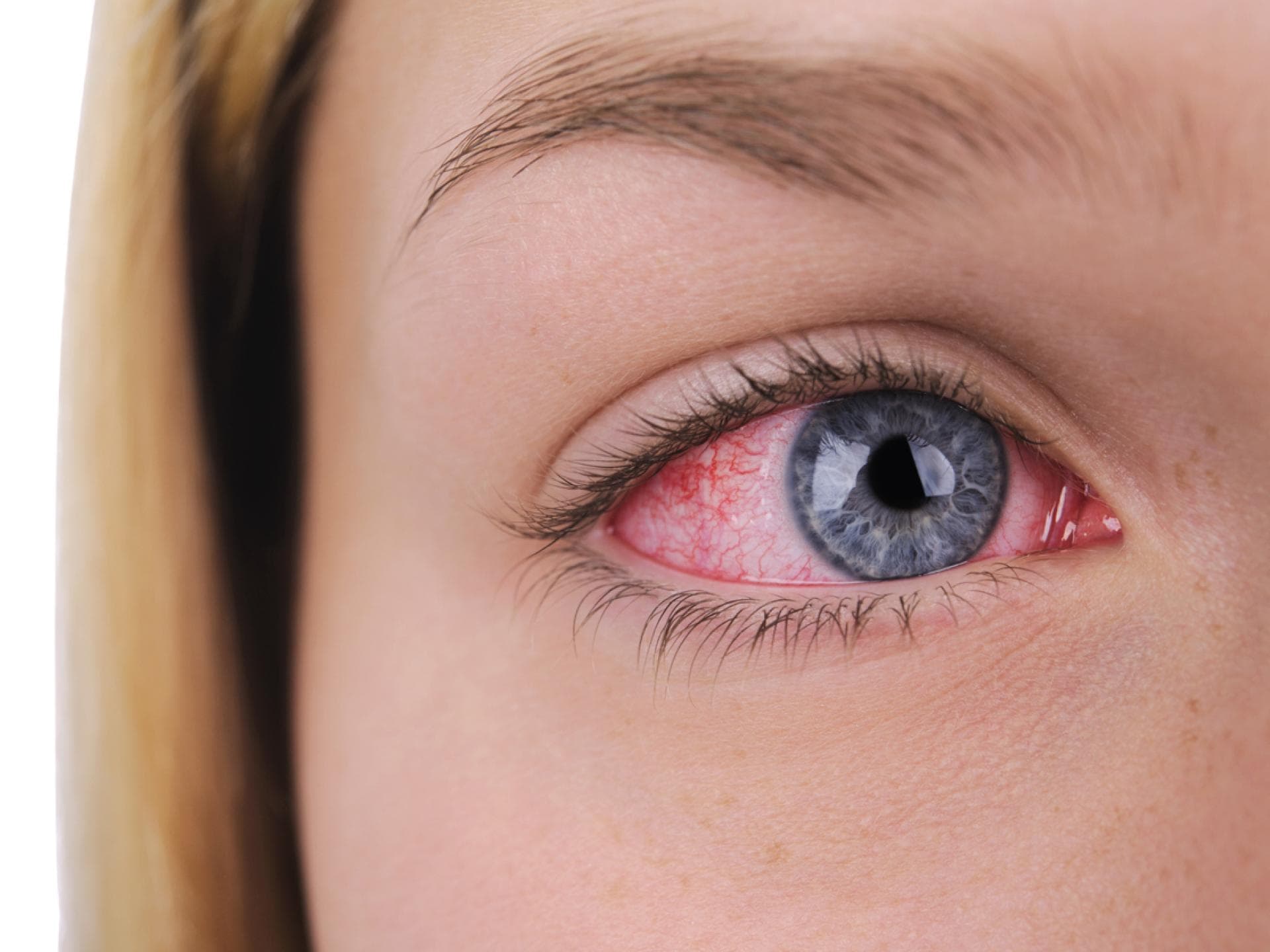Thrombose im Auge