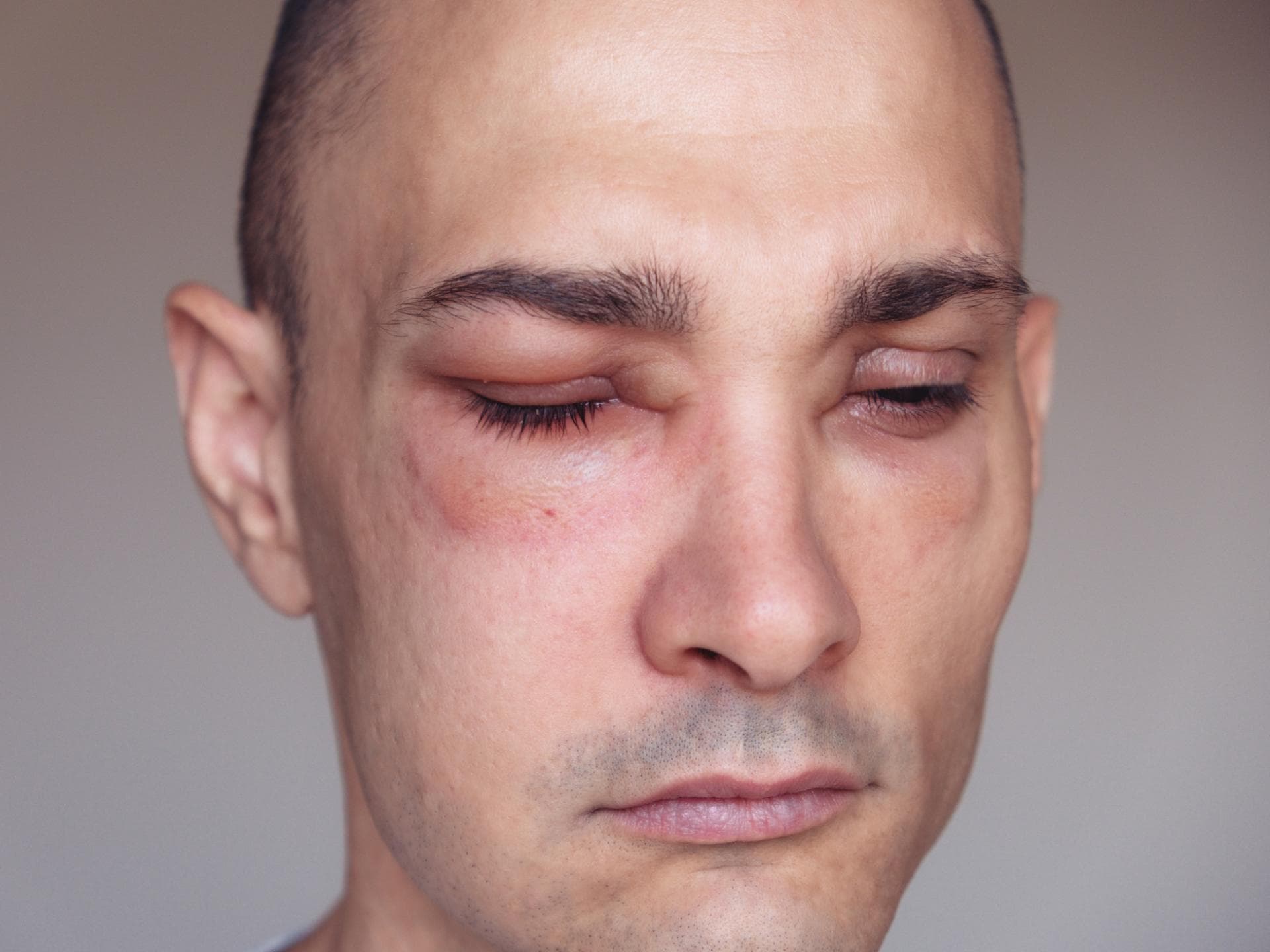 Mann mit allergischen Schwellungen (Angioödem) im Gesicht