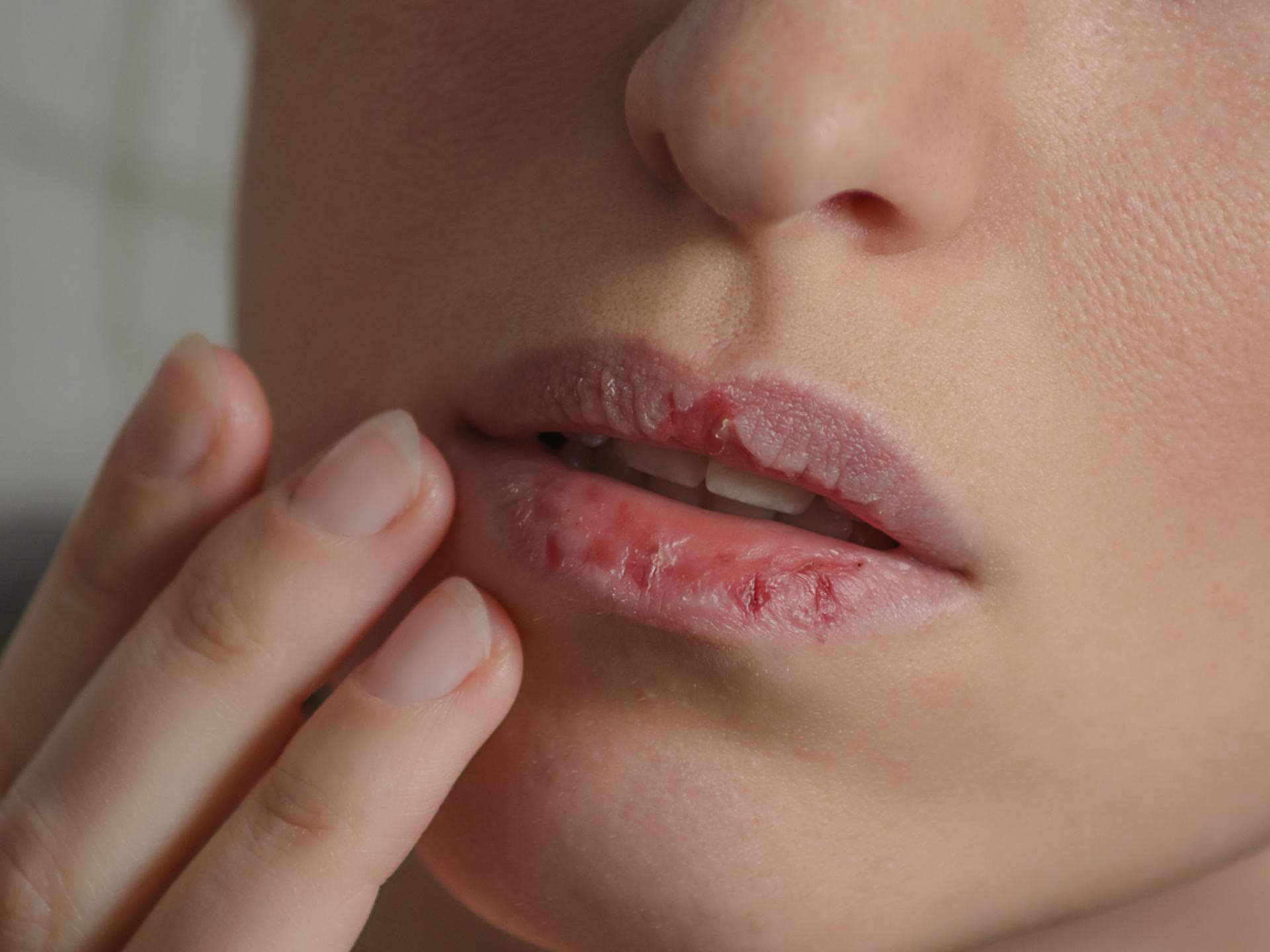 Lippenkrebs