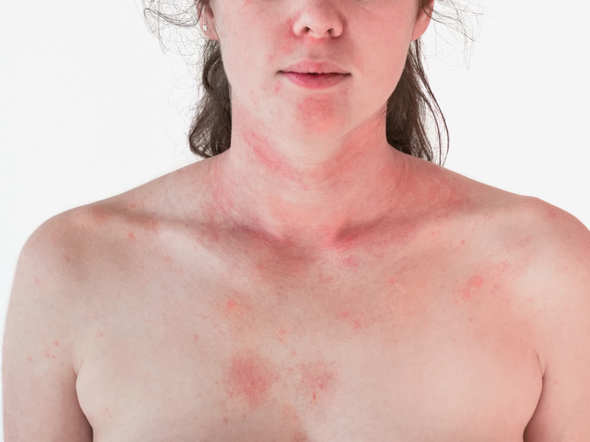 Dermatomyositis