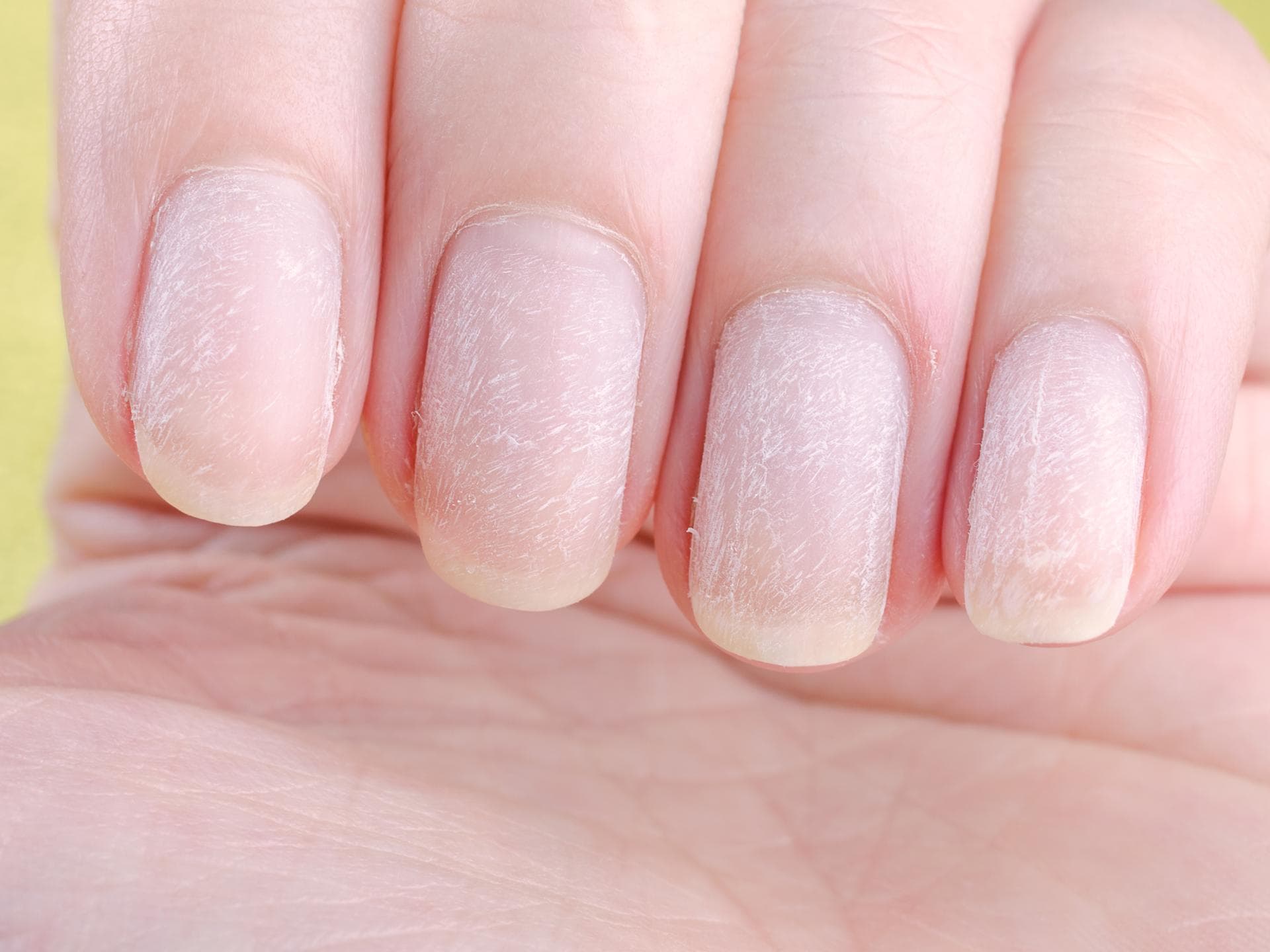 Gelbe und trockene Fingernägel Gelbe und trockene Fingernägel