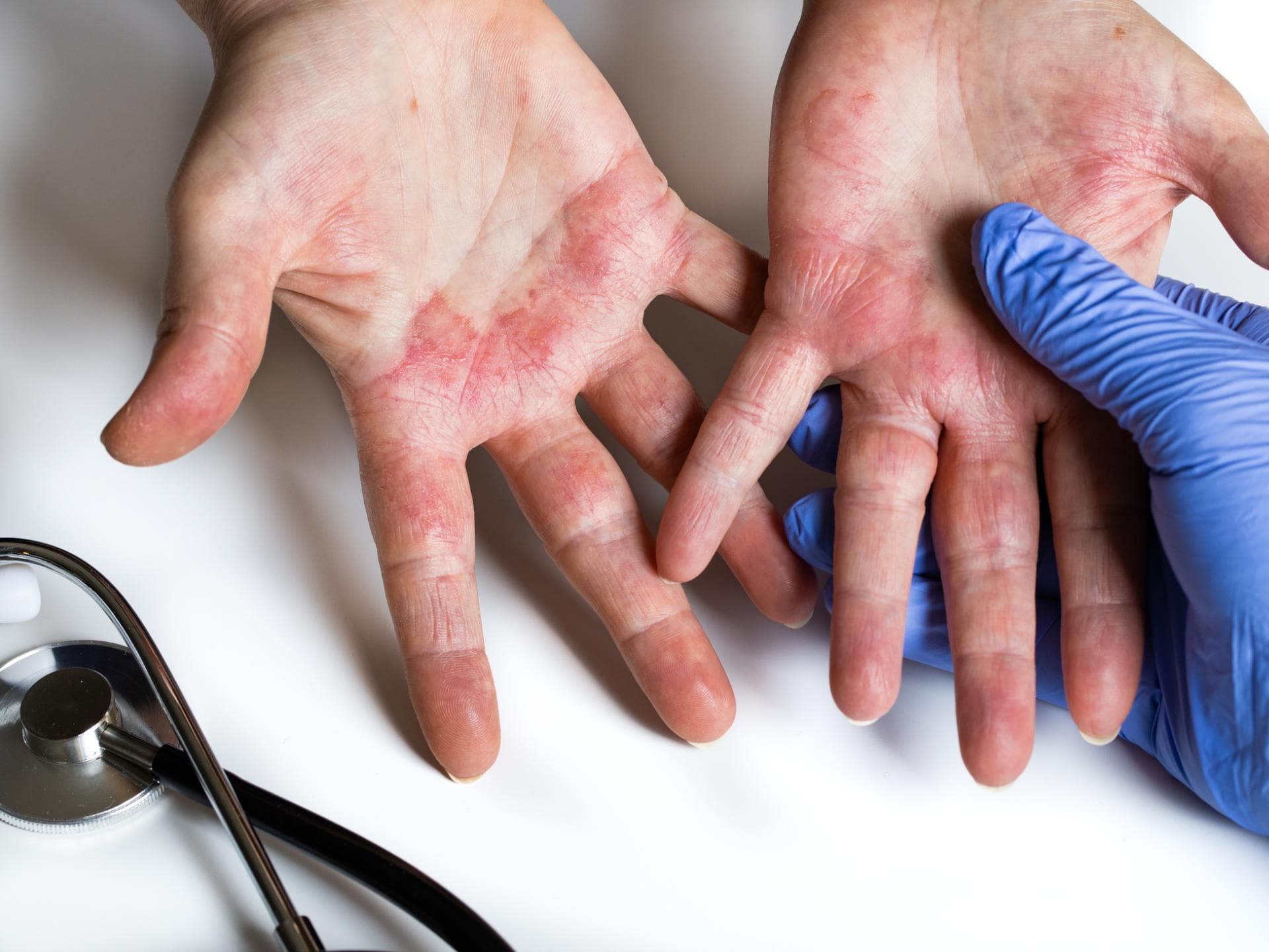 Eine Hand in Latexhandschuhen hält die Hände eines Patienten mit allergischem Ausschlag
