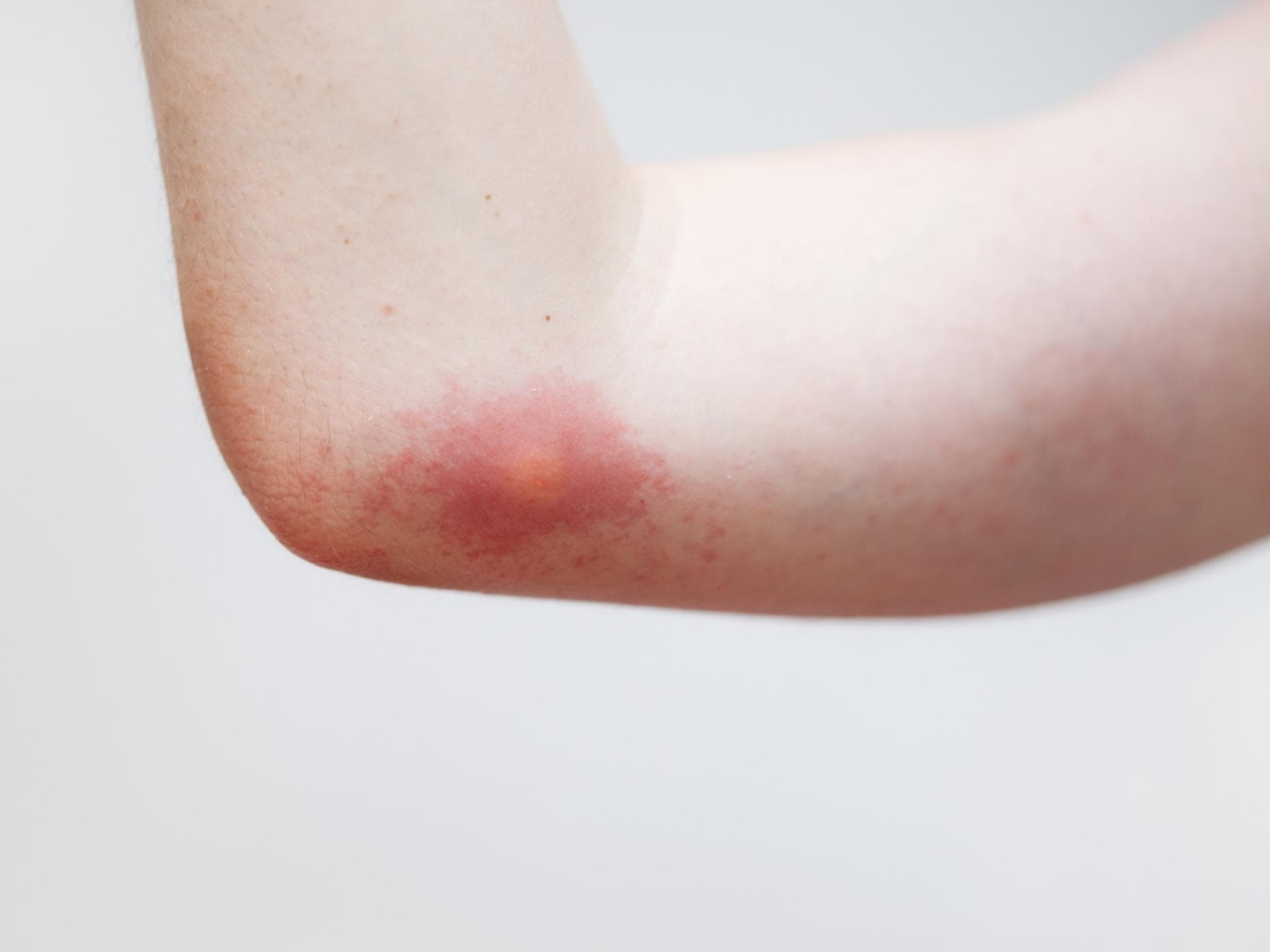 Wespenstich am Arm