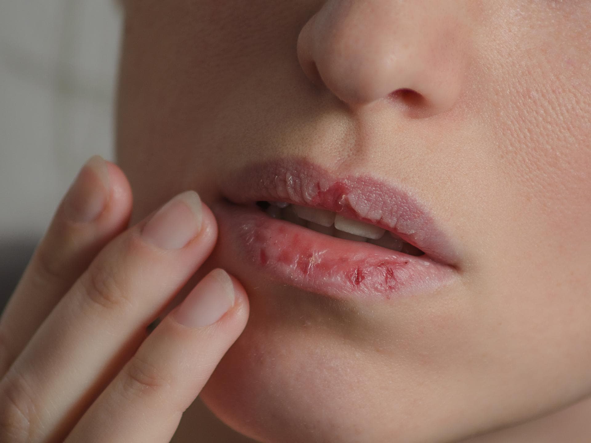 Frau fasst sich an ihre aufgeplatzten Lippen Frau fasst sich an ihre aufgeplatzten Lippen