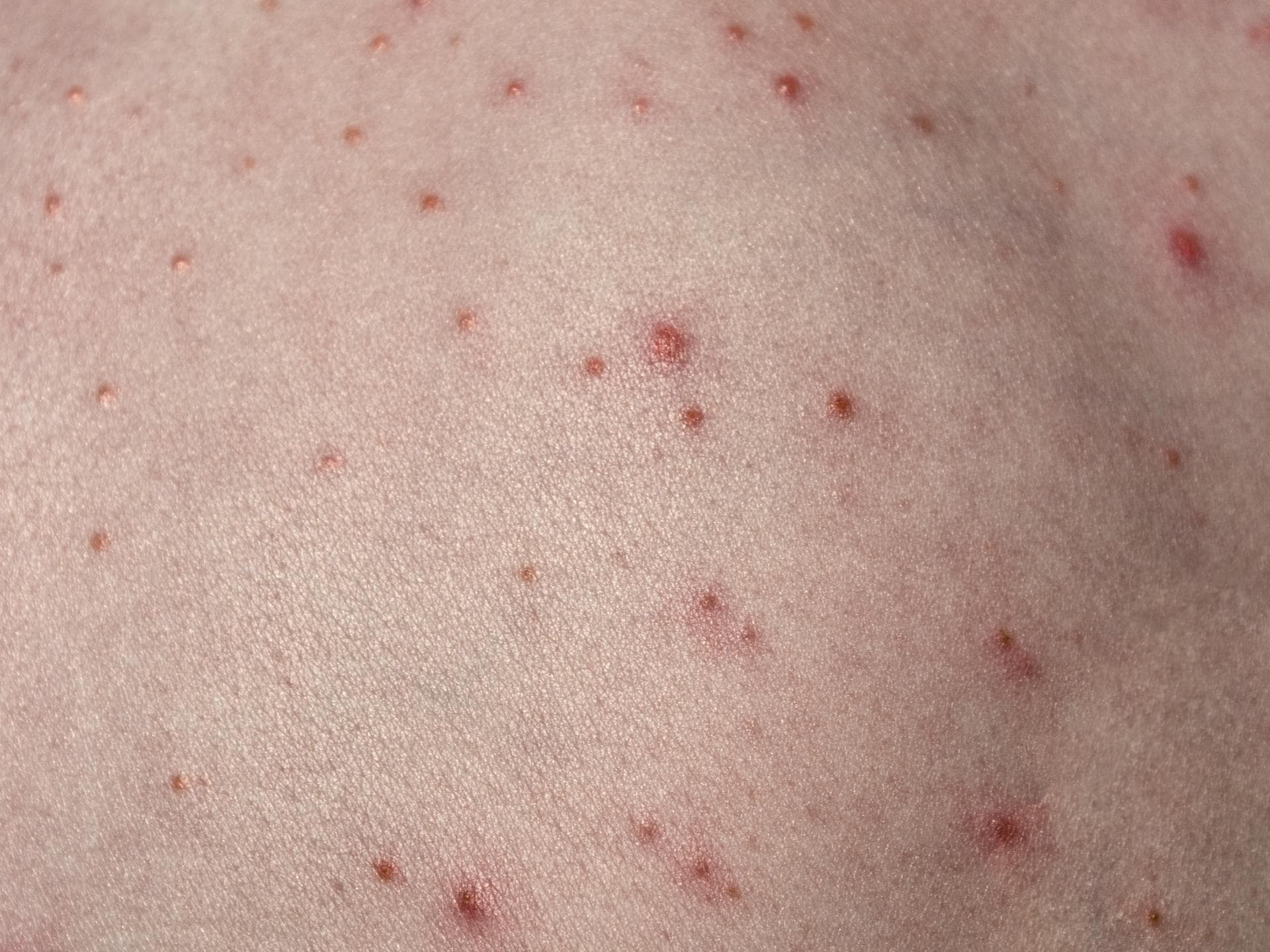 Haut mit roten Pusteln darauf