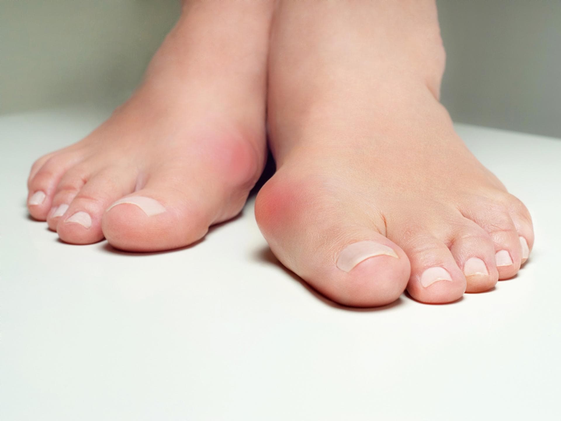 Fuß mit Hallux valgus Fuß mit Hallux valgus