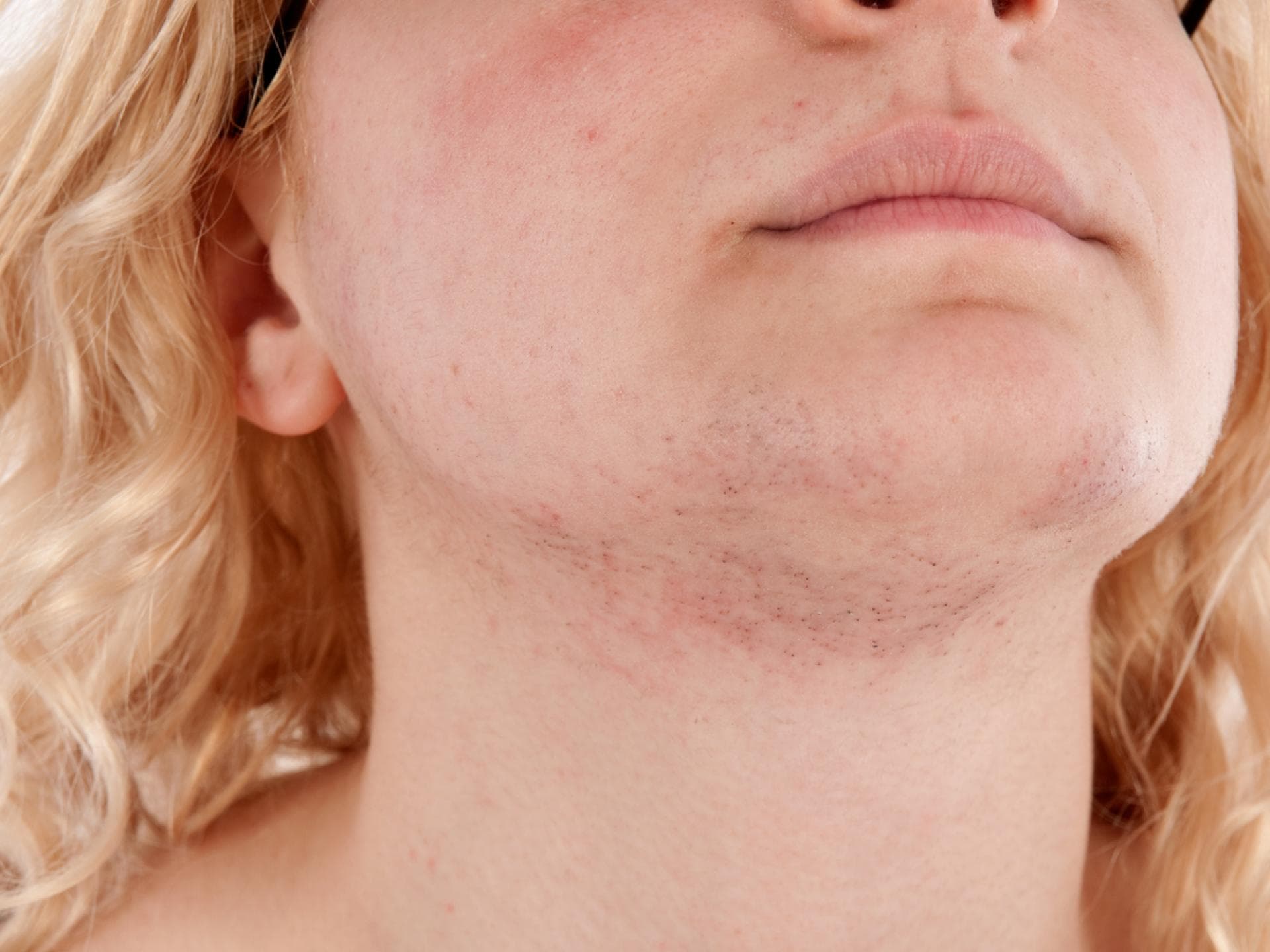 Junge Frau mit Testosteronüberschuss und Kinnbart. Junge Frau mit Testosteronüberschuss und Kinnbart.