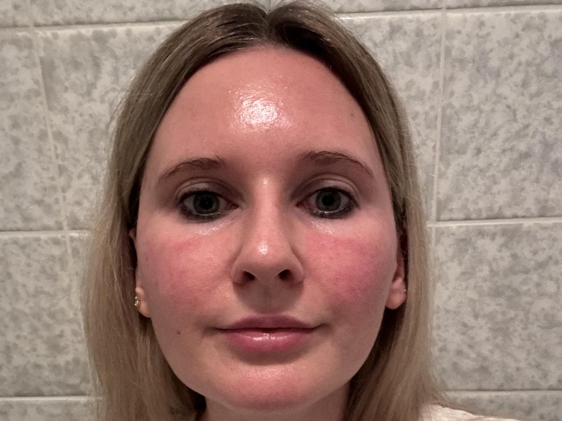 Nach der Gua Sha Massage Nach der Gua Sha Massage