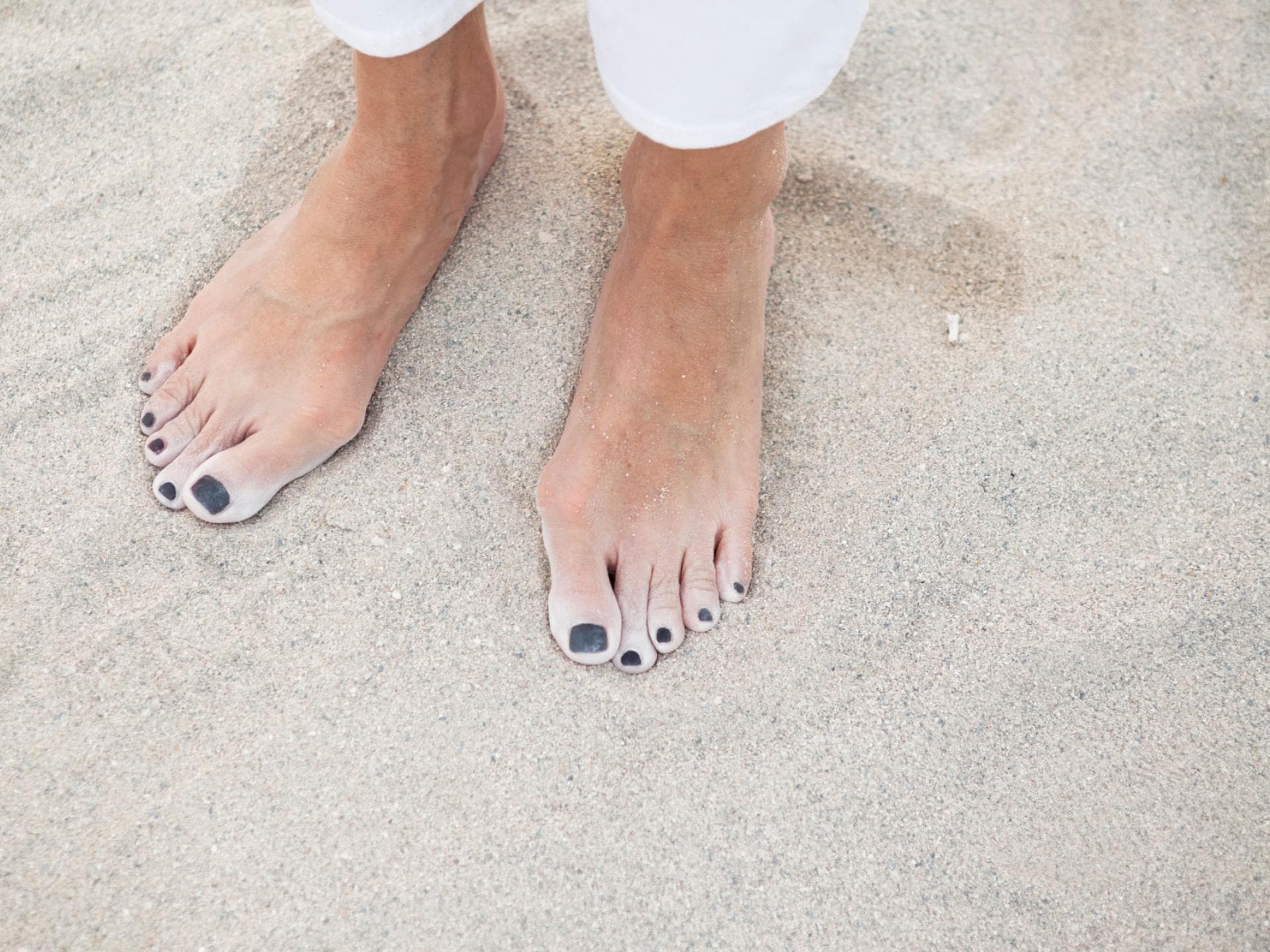 Hallux valgus Ballenzeh bei Frau