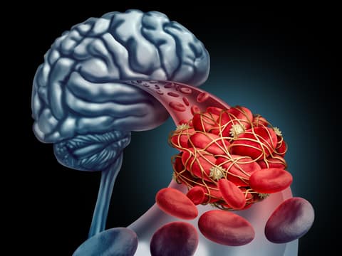 Hirnvenenthrombose