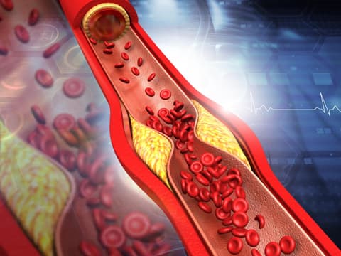  Hohe LDL-Cholesterinspiegel können zu einer Anhäufung von Cholesterin in den Arterien führen