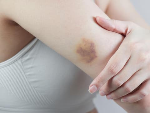 Hämatom am Arm