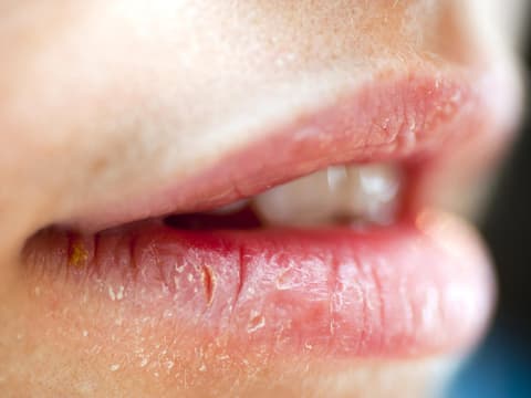 Wunde Lippen