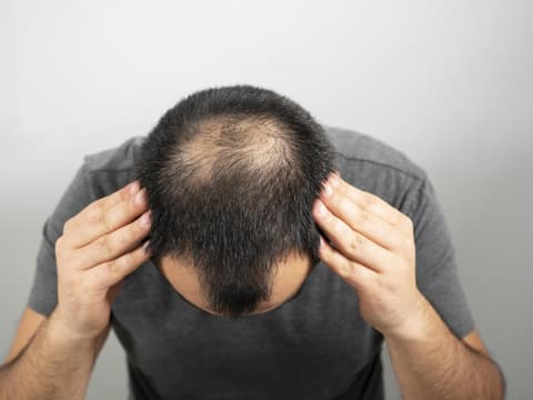 Mann hat Haarausfall